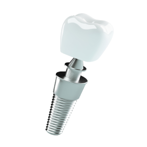 Implante dentário em Taubaté